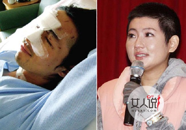 selina俞灏明烧伤图片,俞灏明selina烧伤事件 杨盼盼片场烧伤 selina和俞灏明烧伤事件再度重演