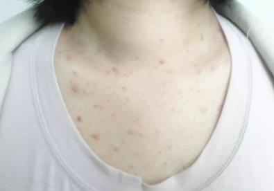 5,螨虫叮咬会出现皮肤暗黄症状